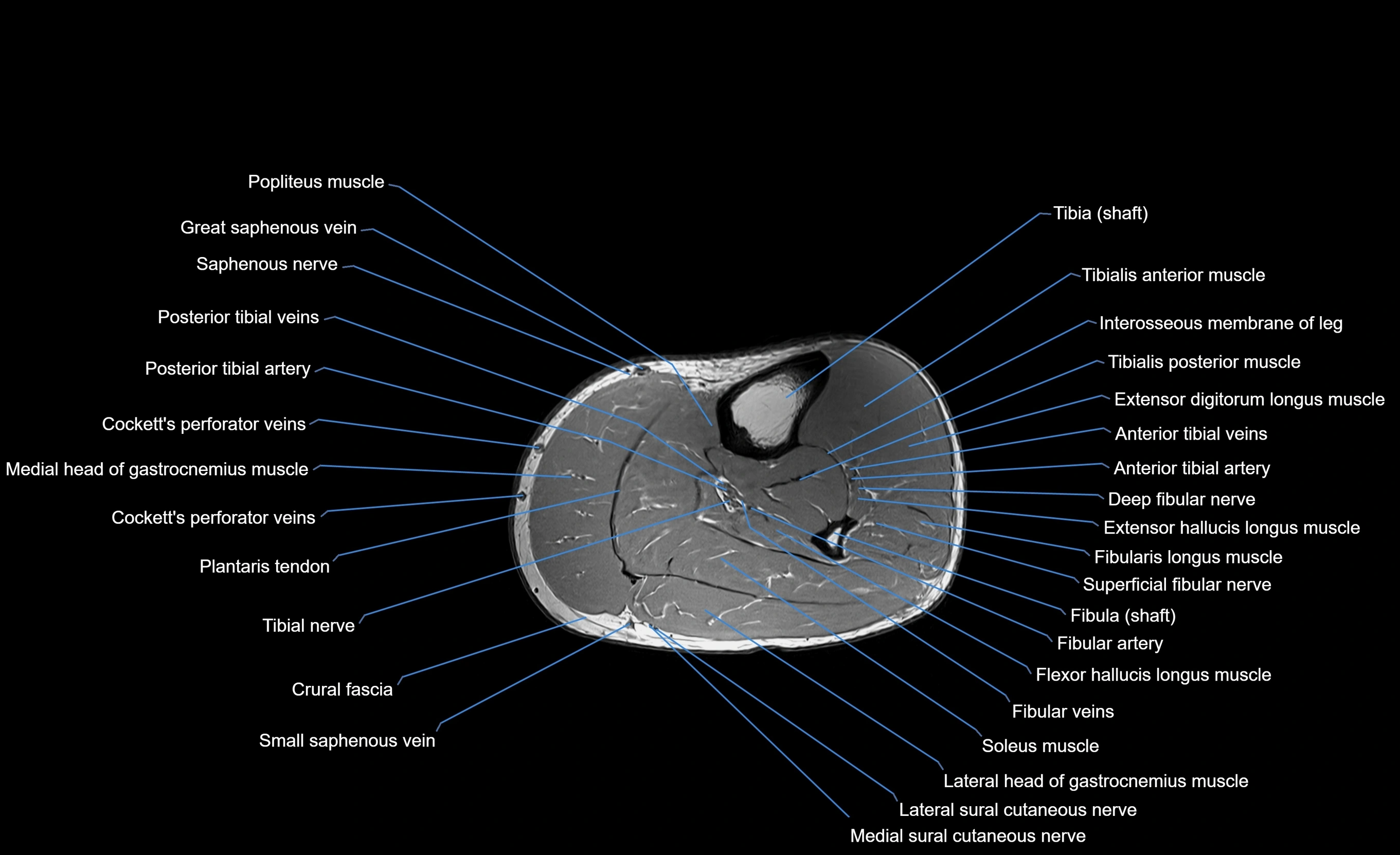 MRI lower leg axial cross sectional anatomy 3T  radiology  image-img-00001-00038.webp